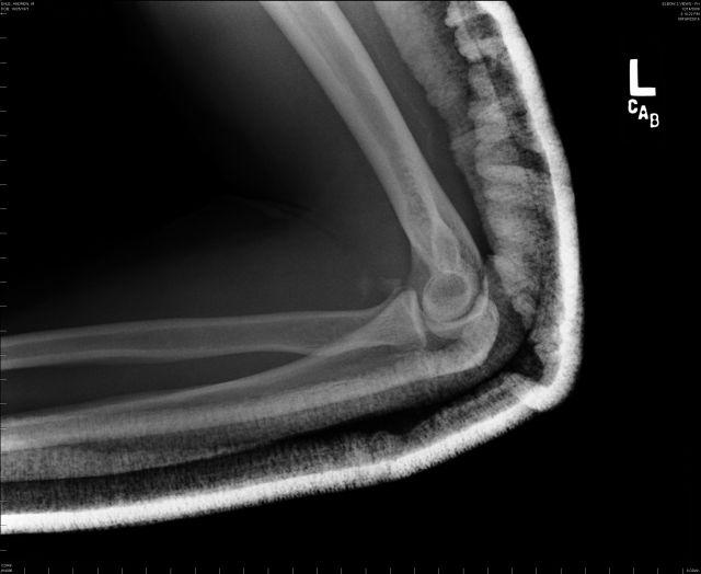 elbow fix.jpg
